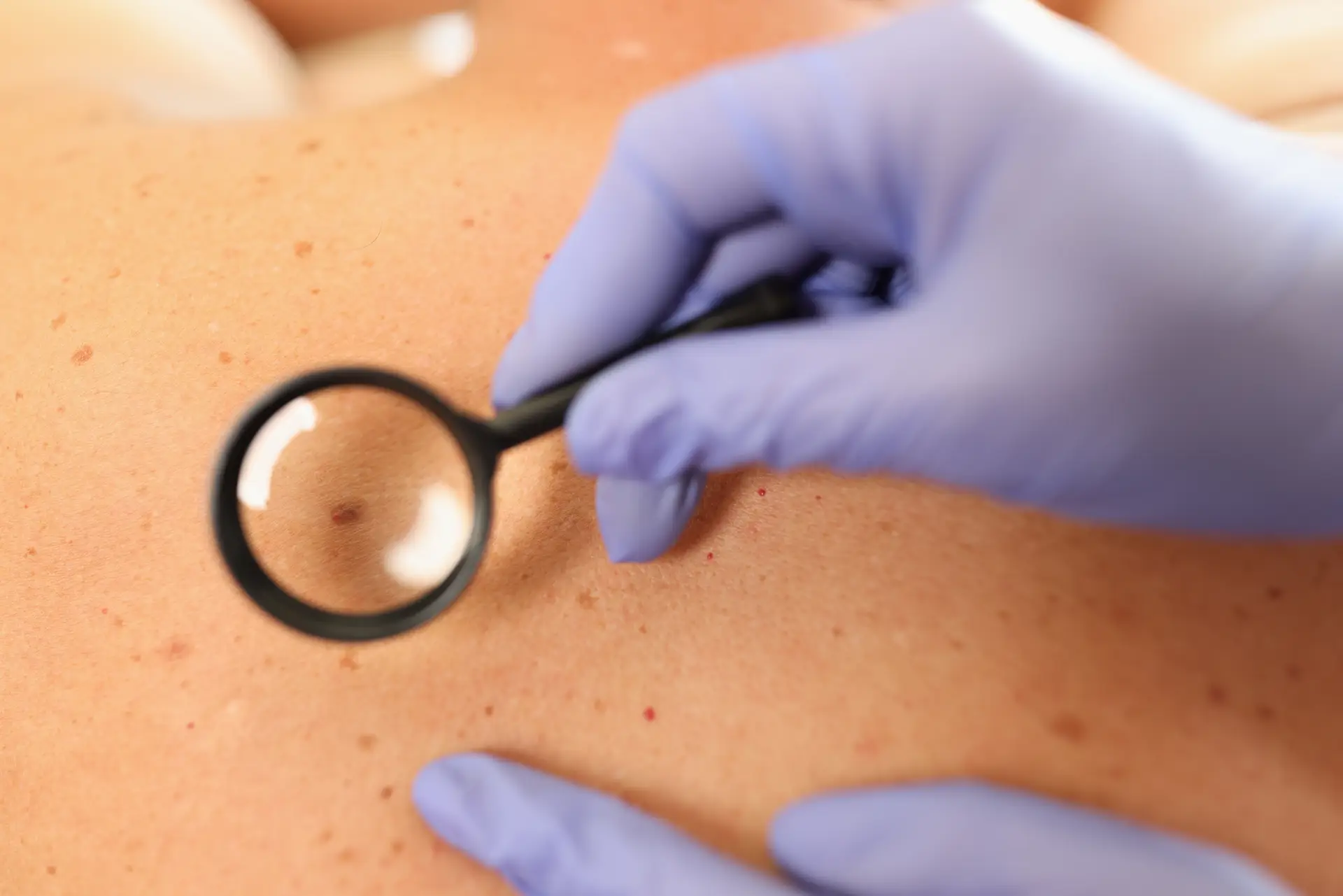 Cryotherapy for Warts